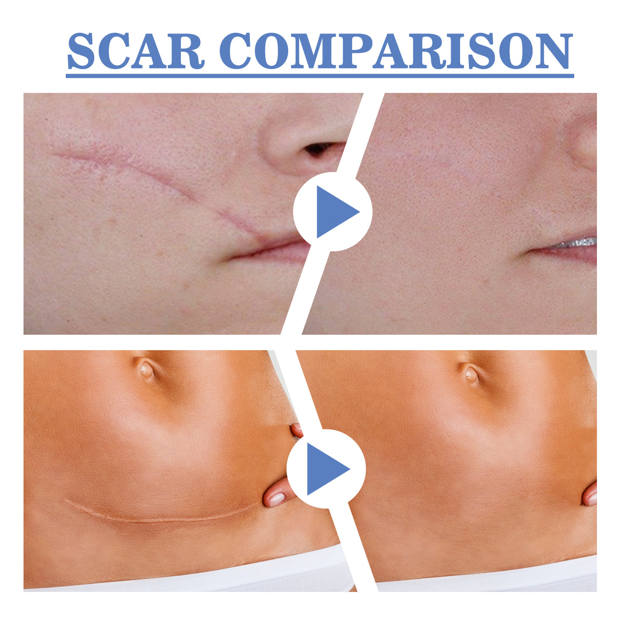 MediPatch Silicone Scar Sheets – Doctor-Tested, Invisible Healing for Surgery, Acne & Burn Scars